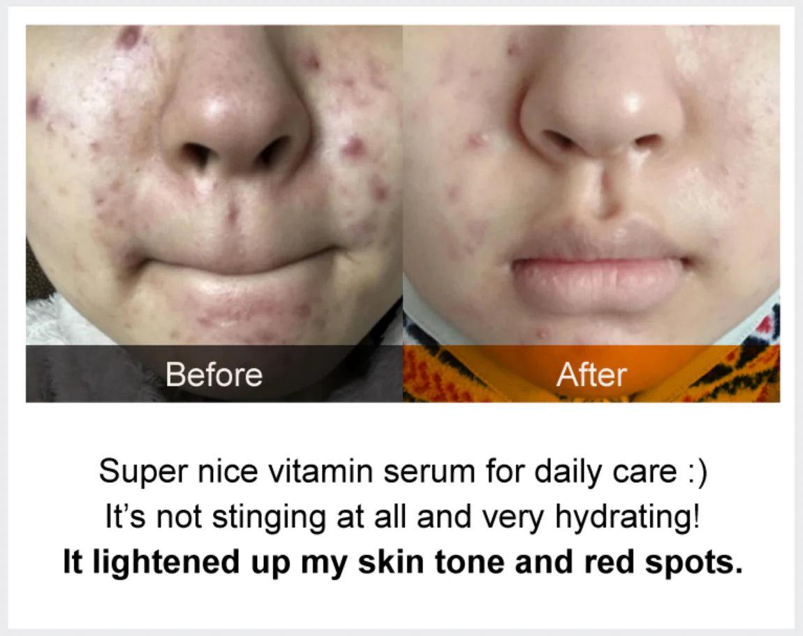 Numbuzin No.5 Goodbye Blemish Serum