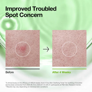 Anua Azelaic Acid 3 Cica Skin Clarifying Tóner