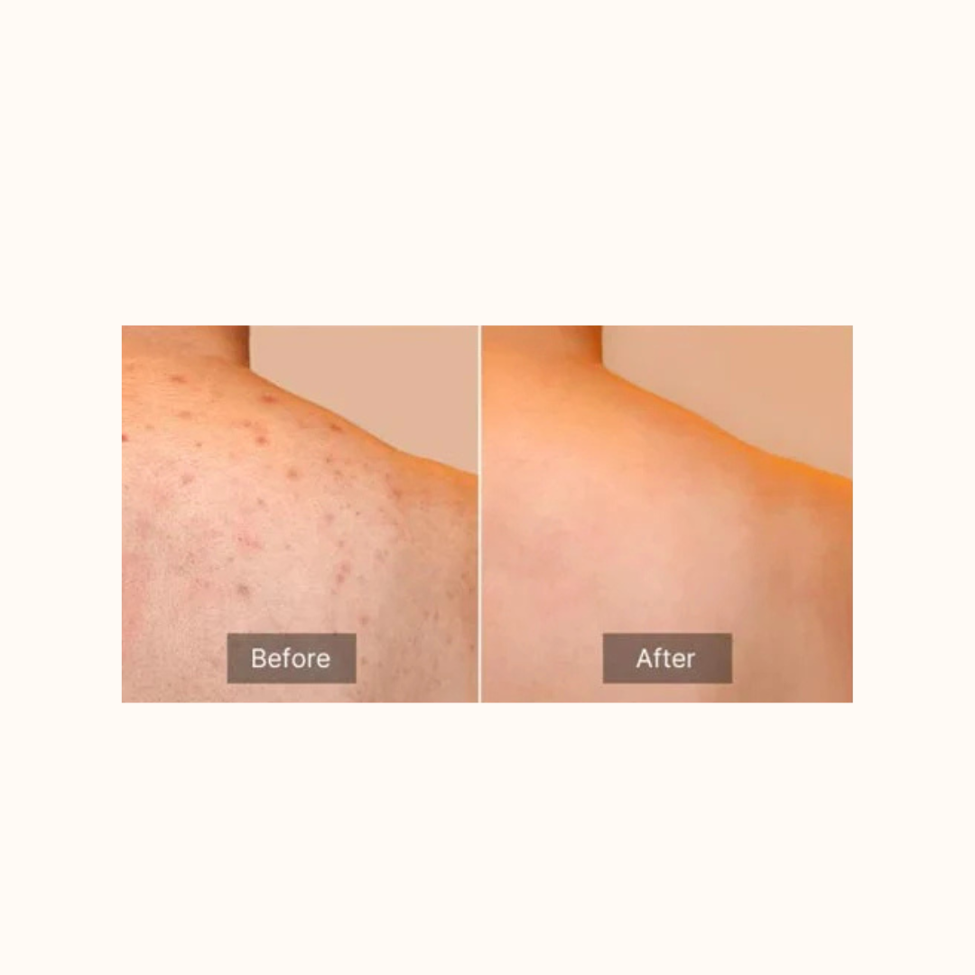 Medicube Red Acne Body Peeling Shot