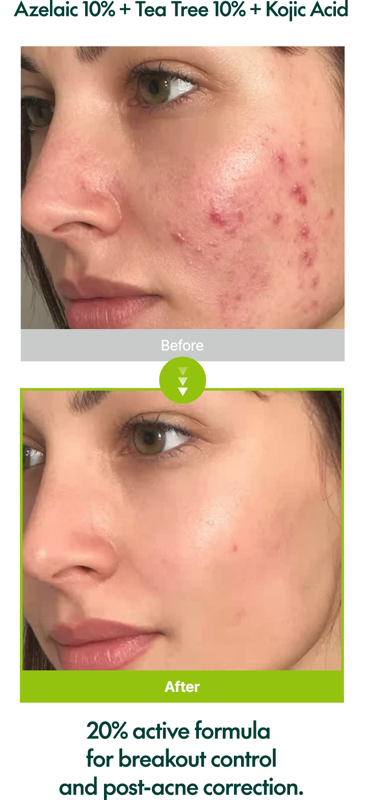 Purito Serum Azelaic Acid 10Kojic Tea Tree