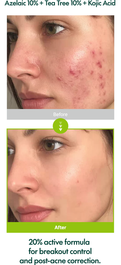 Purito Serum Azelaic Acid 10Kojic Tea Tree